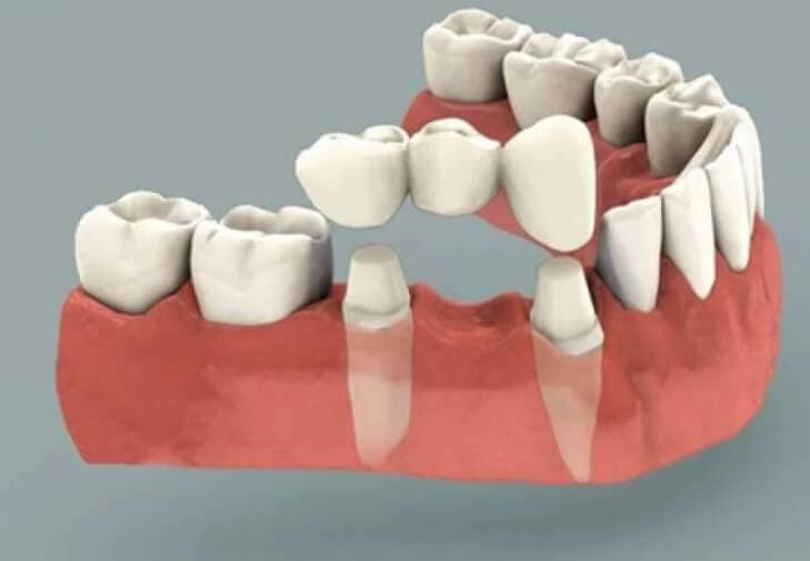 sabit protez diş