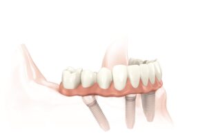 All On Four Implant Tekniği