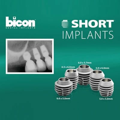 bicon implant