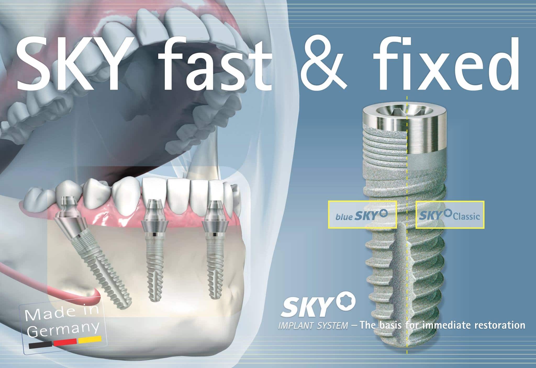 bredent implant nasıldır