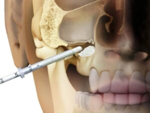 Sinüs Kaldırma (Sinus Lifting)