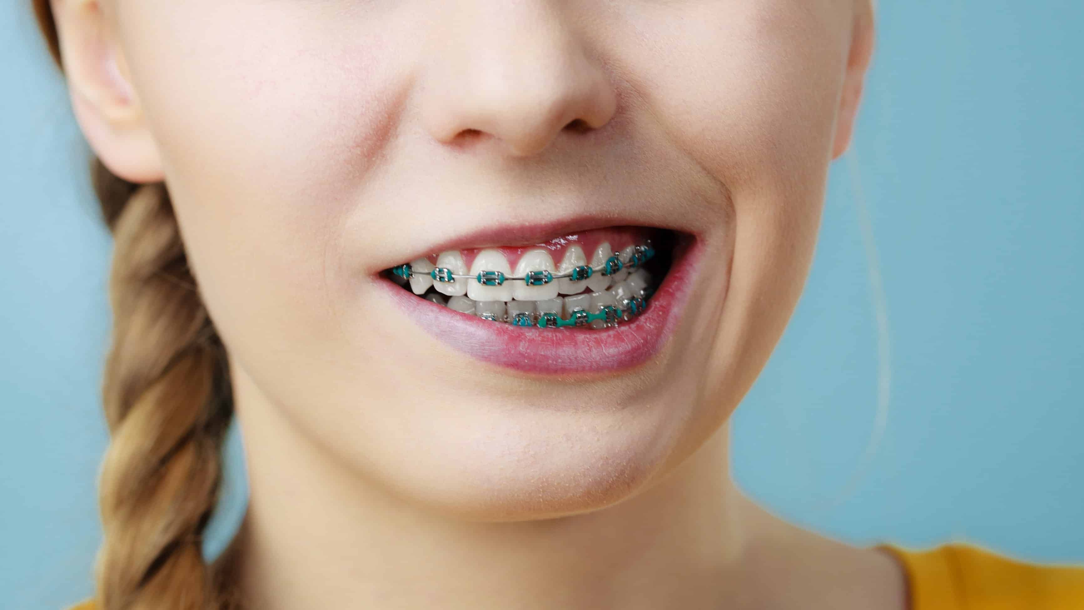Ortodonti Tedavilerinde Braket Kullanımı