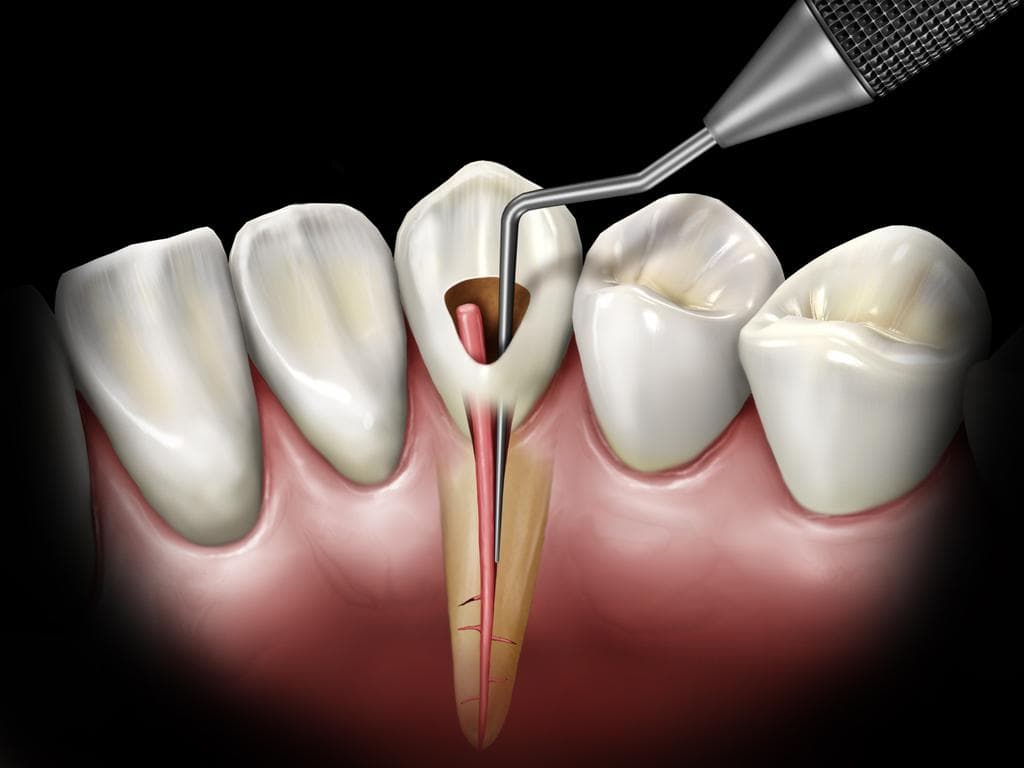 Endodonti İşlemleri Ve Kanal Tedavisi Nasıl Yapılır?
