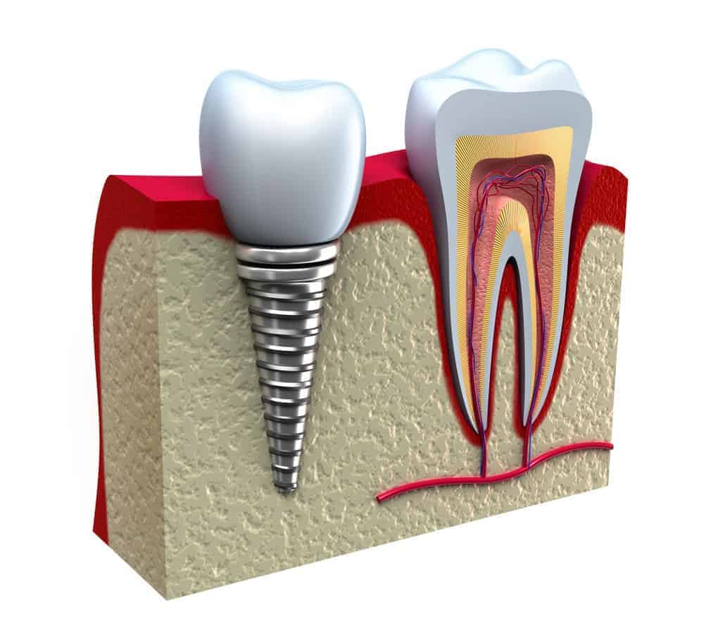 implant diş