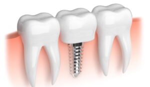 ucuz implant diş nasıl olur