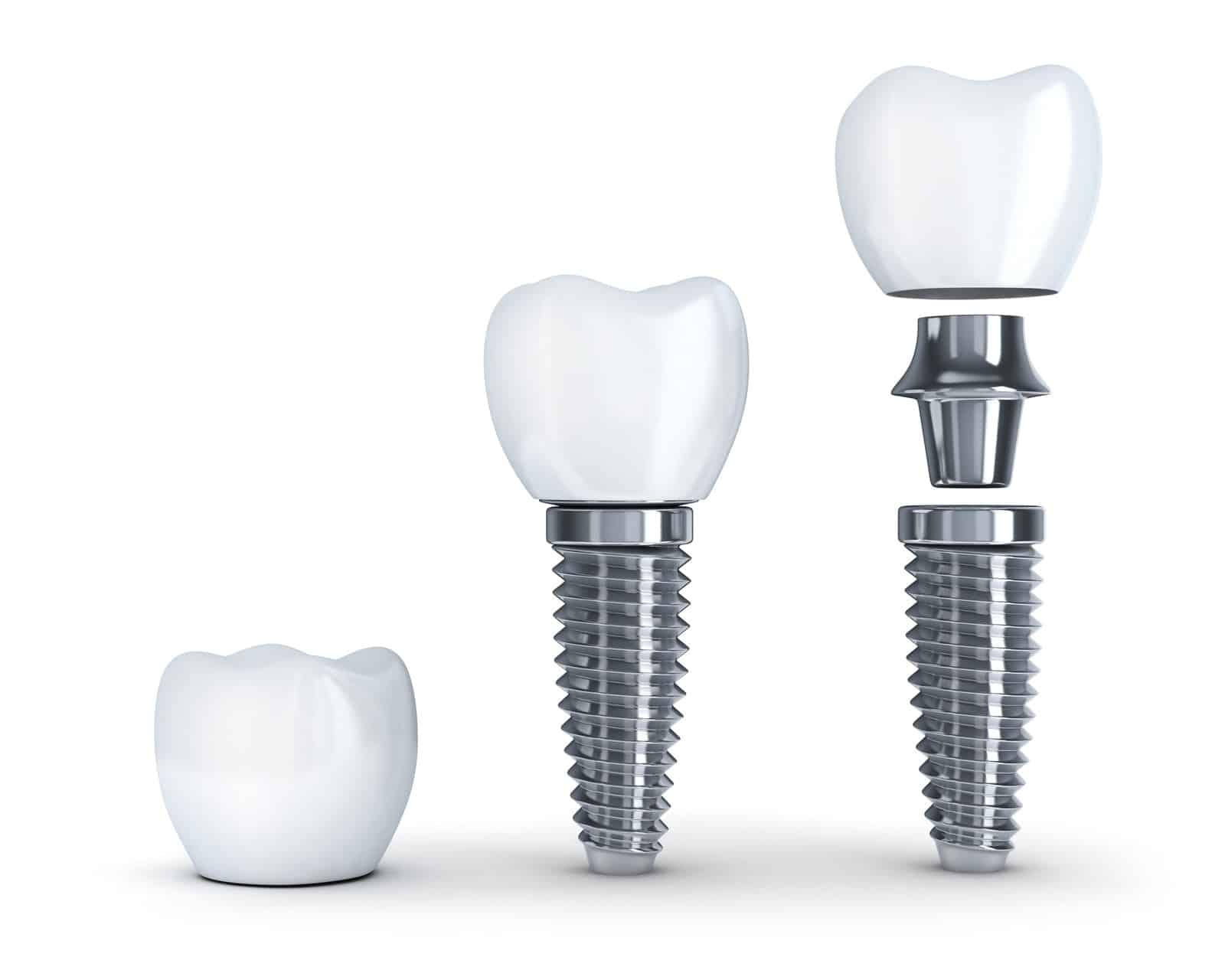 implant diş