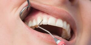 diş taşı temizliği nasıl yapılır
