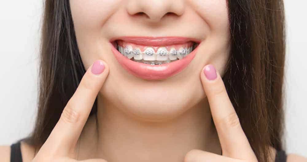 Diş Teli Bakımı Nasıl Yapılmalıdır?