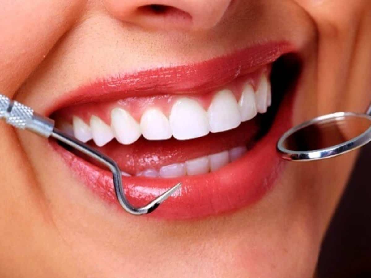 Diş Kaplama Yöntemleri