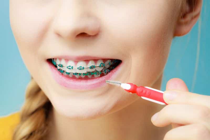 Diş teli tedavisi