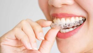 Invisalign Tedavisi Nedir, Süreç Nasıl İşler?