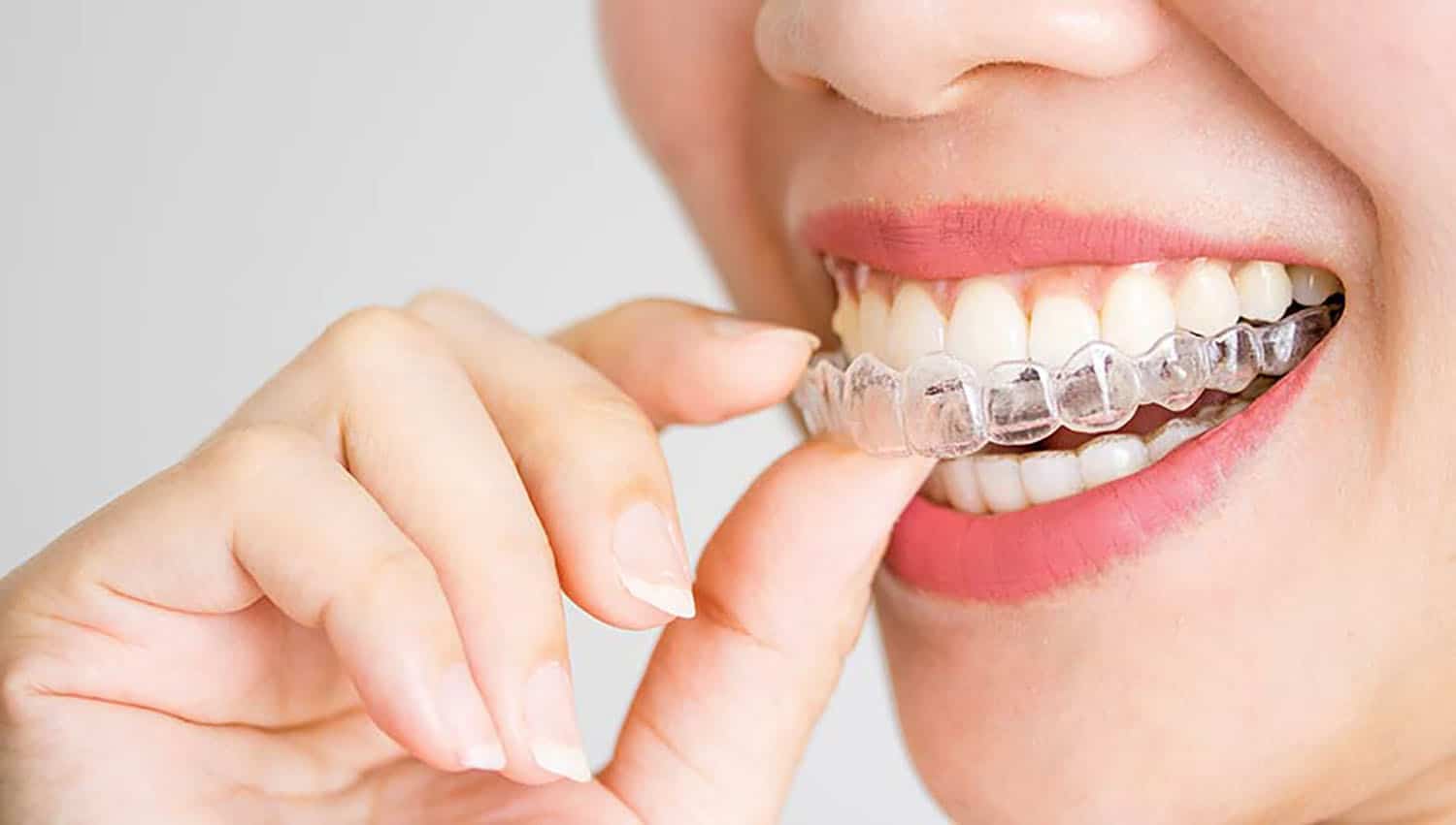Invisalign Tedavisi Nedir, Süreç Nasıl İşler?