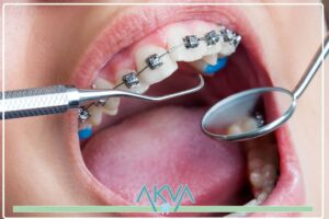 SSK İle Diş Teli Yaptırmak Mümkün Mü? Şartları Nelerdir?