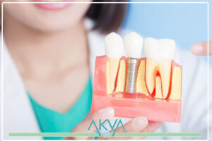 İmplant Diş veya Protez Diş Arasından Hangisi Seçilmeli