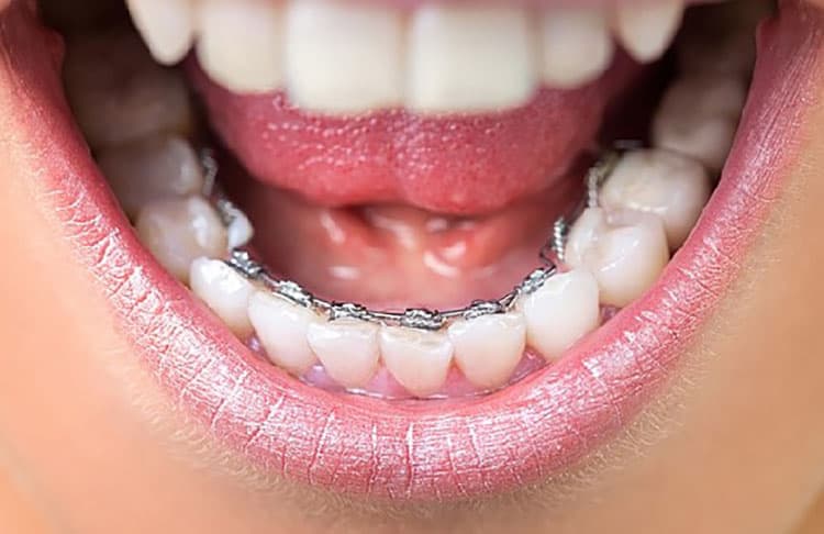 Lingual Diş Teli Tedavisi