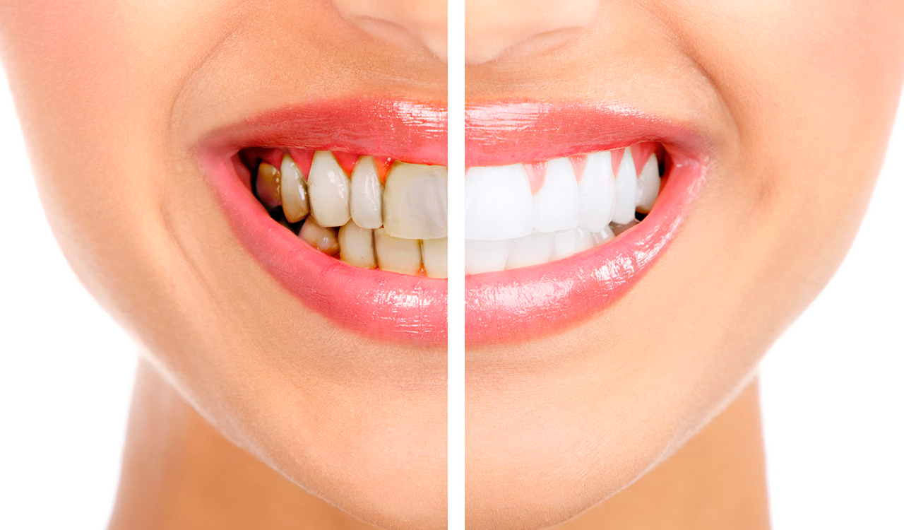 Diş Tartarı Nedir? Diş Tartarı Temizliği Nasıl Yapılır?