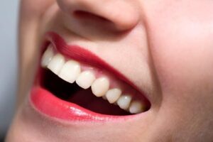 Diş Eti Morarması Nedir?