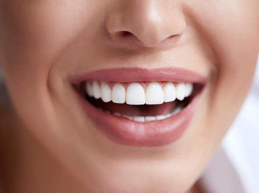 Lazer diş beyazlatma tedavisi