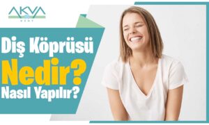 Diş Köprüsü Nedir? Diş Köprüsü Çeşitleri Nelerdir?