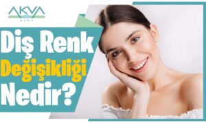 Diş Renk Değişikliği