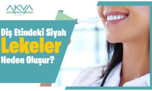 Diş Etindeki Siyah Lekeler Neden Oluşur?