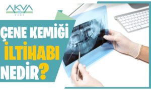 Çene Kemiği İltihabı Nedir? Çene Kemiği İltihabı Belirtileri Nelerdir?