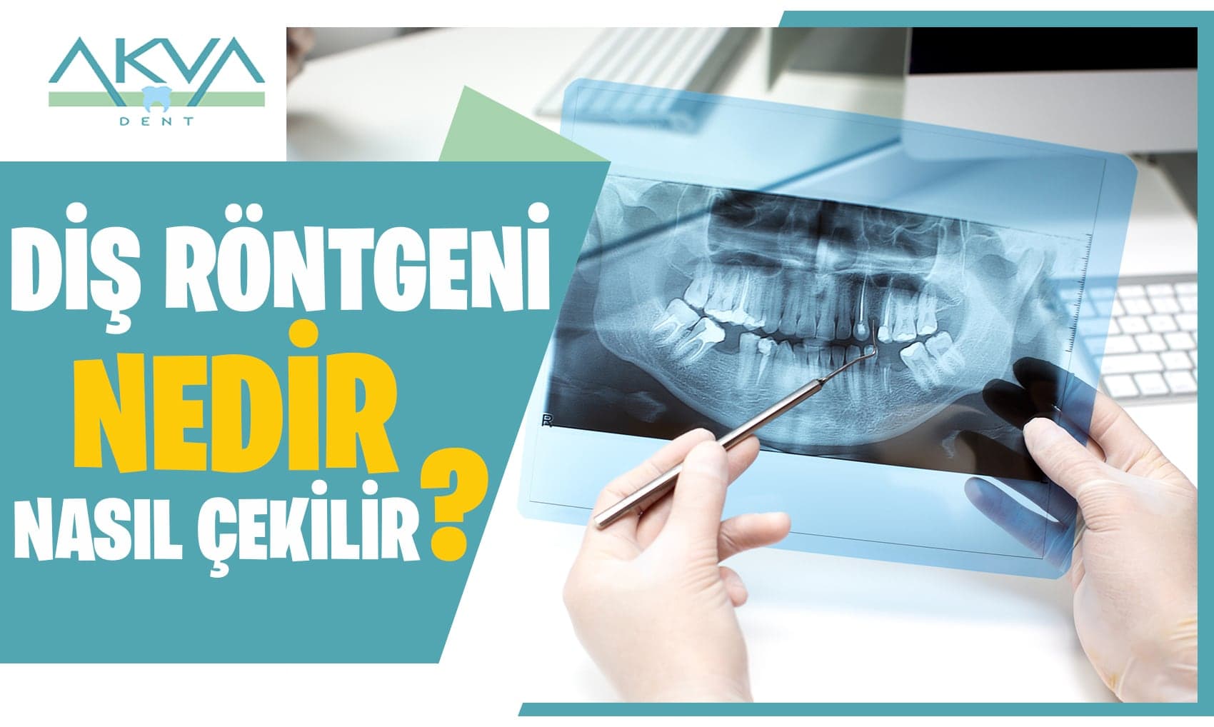 Diş Röntgeni Nedir? Diş Röntgeni Nasıl Çekilir?