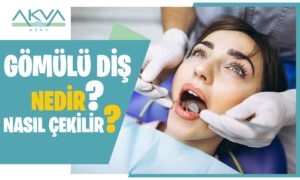 Gömülü Diş Nedir?