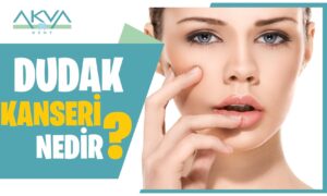 Dudak Kanseri Nedir? Dudak Kanseri Belirtileri Nelerdir?