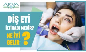 Diş Eti İltihabı Nedir? Diş Eti İltihabına Ne İyi Gelir?