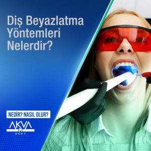 Diş Beyazlatma Yöntemleri