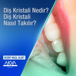 Diş Kristali Nedir? Diş Kristali Nasıl Takılır?